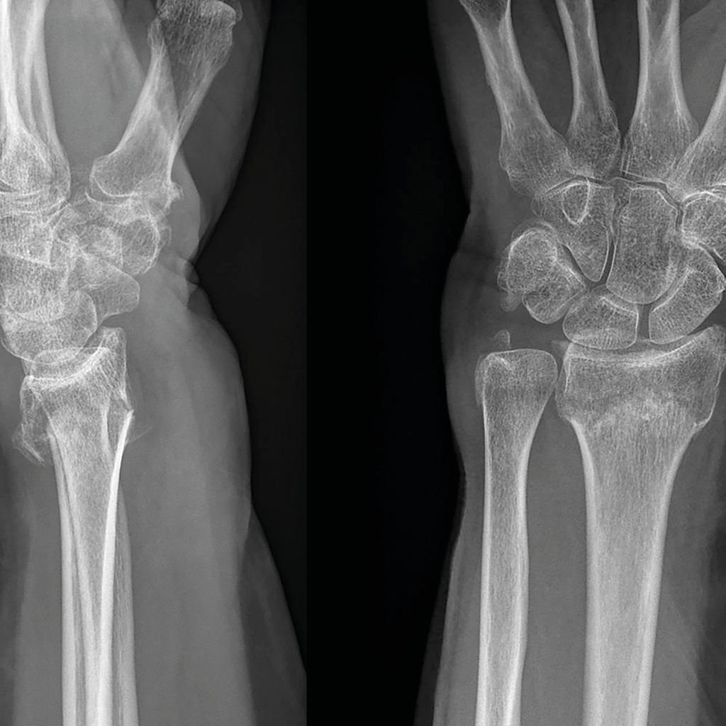 Die Behandlung distaler Radiusfrakturen im Alter eine fast tägliche Orthopädie